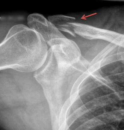 broken collarbone