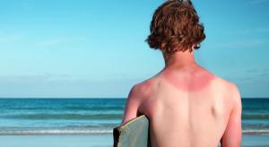 man with sunburned shoulders